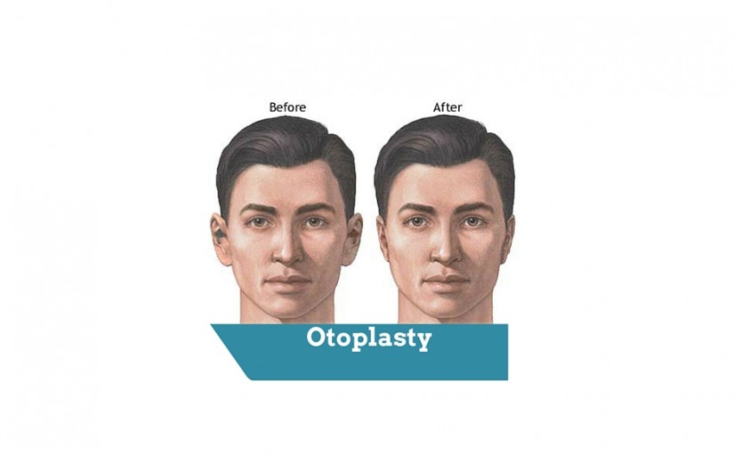 Is otoplasty in London a cheap cosmetic procedure